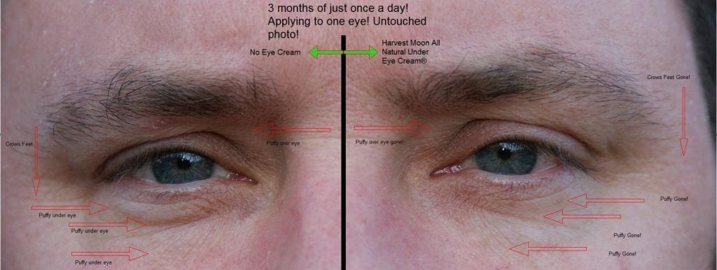 before and after best under eye cream